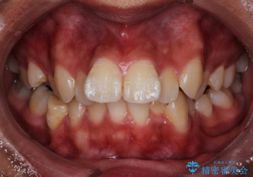 歯のがたがた　出っ歯　横顔も美しくの症例 治療前