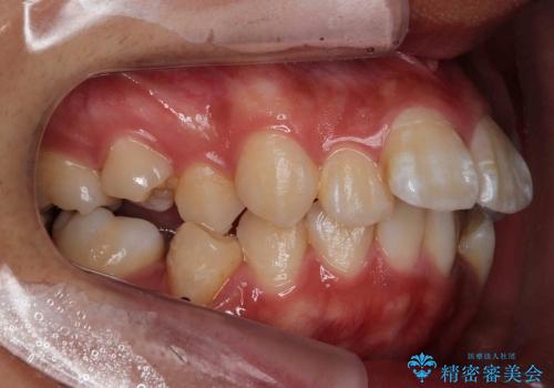 歯のがたがた　出っ歯　横顔も美しくの治療前