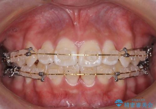 歯のがたがた　出っ歯　横顔も美しくの治療中