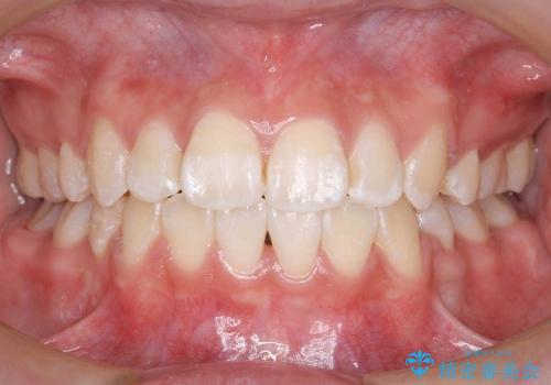 歯のがたがた　出っ歯　横顔も美しくの症例 治療後