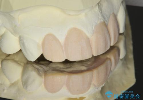 オールセラミックによる歯並びの改善の治療中