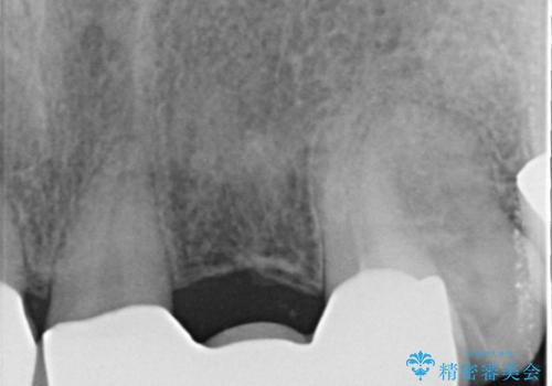 前歯ブリッジ　虫歯再発によるやりかえ治療の治療後