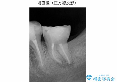 精密根管治療(イニシャルトリートメント):強度の湾曲根管を持つ大臼歯の症例の治療後
