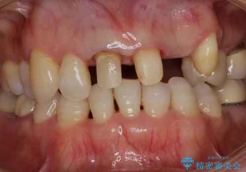前歯ブリッジ　虫歯再発によるやりかえ治療の治療中