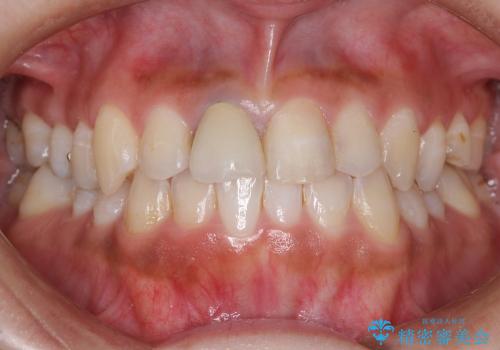 部分矯正+上の前歯のセラミックの治療前