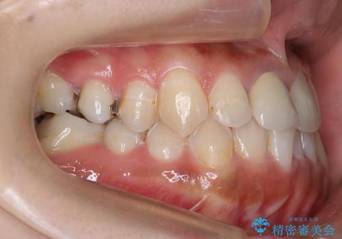 部分矯正+上の前歯のセラミックの治療前