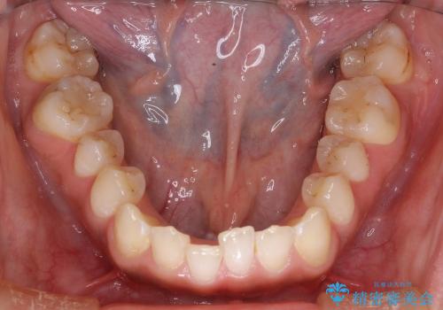 部分矯正+上の前歯のセラミック