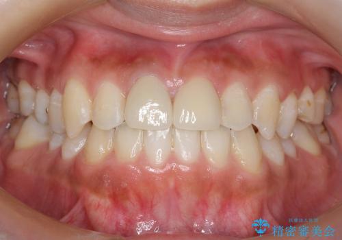 部分矯正+上の前歯のセラミックの症例 治療後