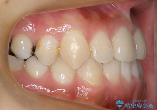 部分矯正+上の前歯のセラミックの治療後