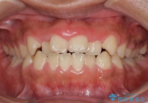 [10代男性] 前歯のがたがた　歯を抜かない矯正治療の症例 治療前