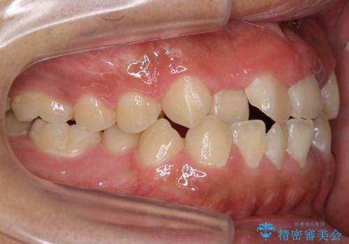 [10代男性] 前歯のがたがた　歯を抜かない矯正治療の治療前