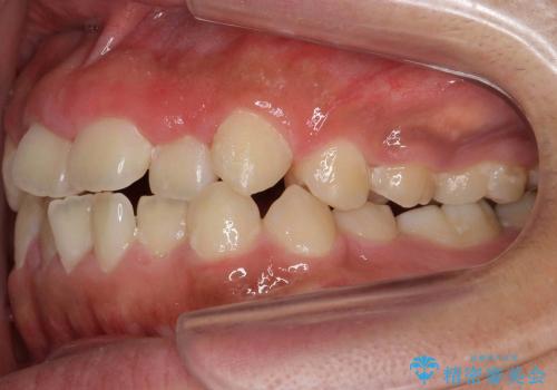 [10代男性] 前歯のがたがた　歯を抜かない矯正治療の治療前