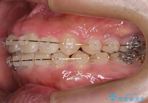 [10代男性] 前歯のがたがた　歯を抜かない矯正治療の治療中