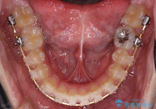 [10代男性] 前歯のがたがた　歯を抜かない矯正治療の治療中