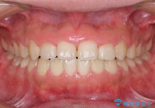 [10代男性] 前歯のがたがた　歯を抜かない矯正治療の症例 治療後
