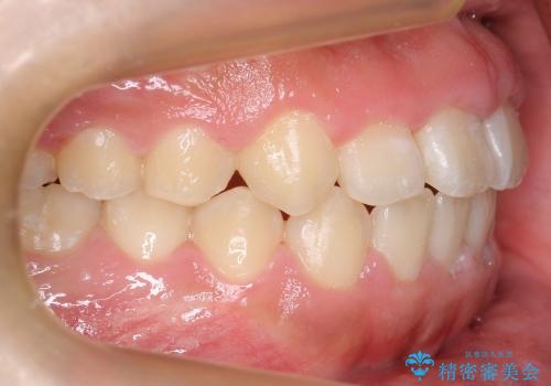 [10代男性] 前歯のがたがた　歯を抜かない矯正治療の治療後
