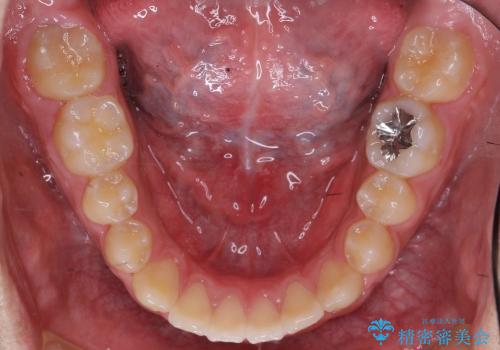 [10代男性] 前歯のがたがた　歯を抜かない矯正治療の治療後