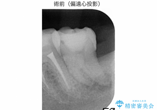 精密根管治療(イニシャルトリートメント):強度の湾曲根管を持つ大臼歯の症例の治療前