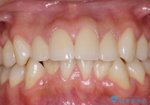 オールセラミックによる歯並びの改善の症例 治療後