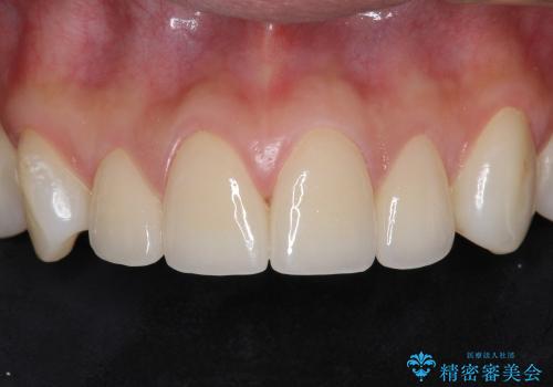 オールセラミックによる歯並びの改善