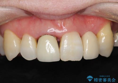 前歯ブリッジ　虫歯再発によるやりかえ治療の症例 治療前