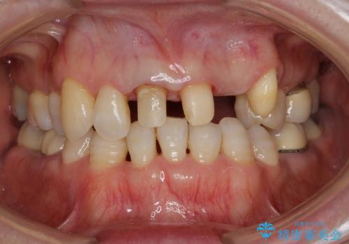 前歯ブリッジ　虫歯再発によるやりかえ治療の治療中