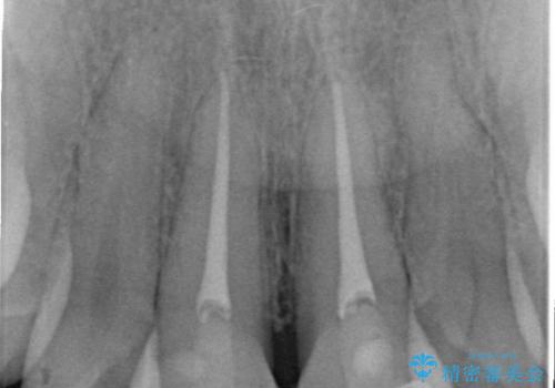 オールセラミックによる歯並びの改善の治療中