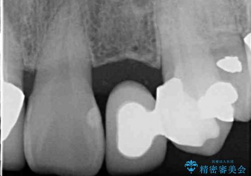 前歯ブリッジ　虫歯再発によるやりかえ治療の治療前