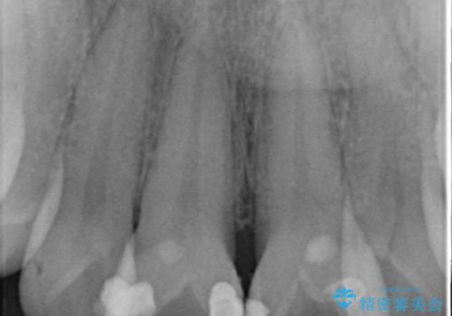オールセラミックによる歯並びの改善の治療前