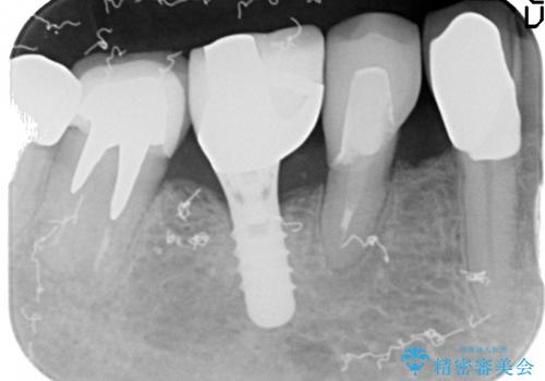 40代女抜歯適応の歯を保存した一例の治療後
