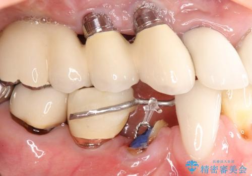 40代女抜歯適応の歯を保存した一例の治療中