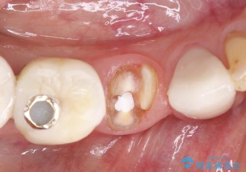 40代女抜歯適応の歯を保存した一例の治療中