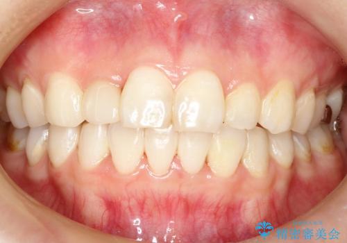全顎矯正およびセラミックによる矮小前歯の形態回復の症例 治療後