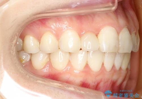 全顎矯正およびセラミックによる矮小前歯の形態回復の治療後