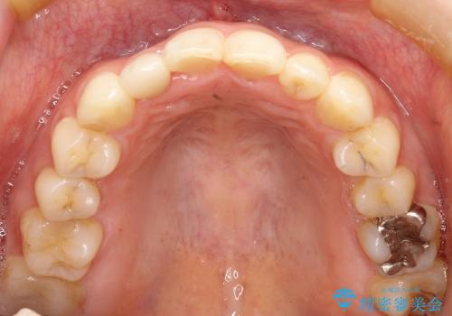 全顎矯正およびセラミックによる矮小前歯の形態回復の治療後