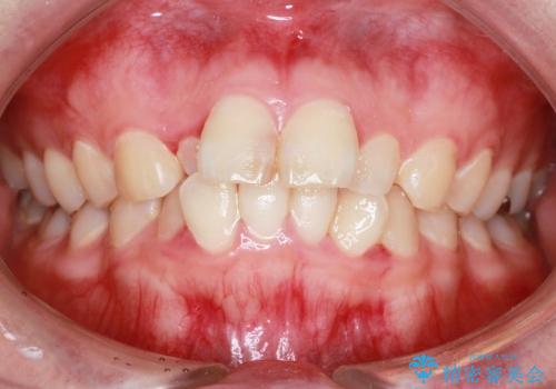 全顎矯正およびセラミックによる矮小前歯の形態回復の症例 治療前