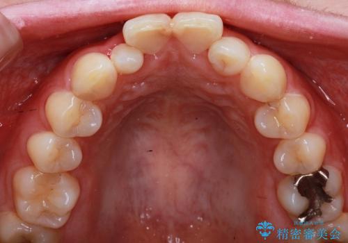 全顎矯正およびセラミックによる矮小前歯の形態回復の治療前