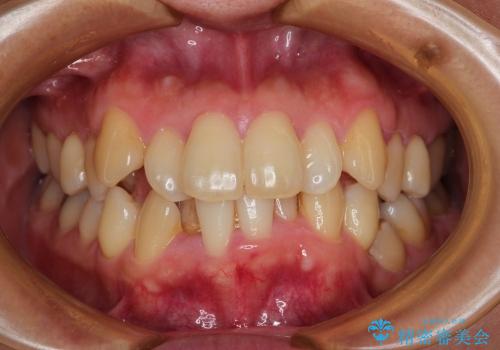 30代女性 ハーフリンガル 1年半の抜歯矯正の症例 治療前
