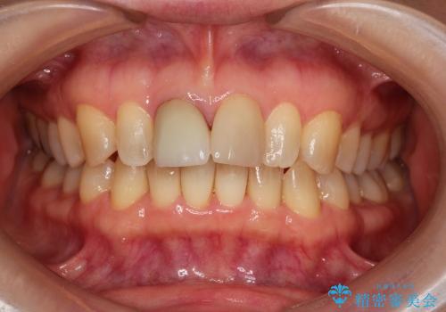 前歯セラミックやり替え治療(40代女性)の治療前
