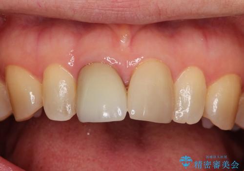 前歯セラミックやり替え治療(40代女性)の症例 治療前