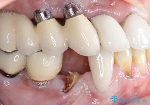 40代女抜歯適応の歯を保存した一例の治療前