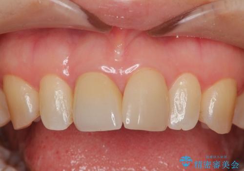 前歯セラミックやり替え治療(40代女性)の症例 治療後
