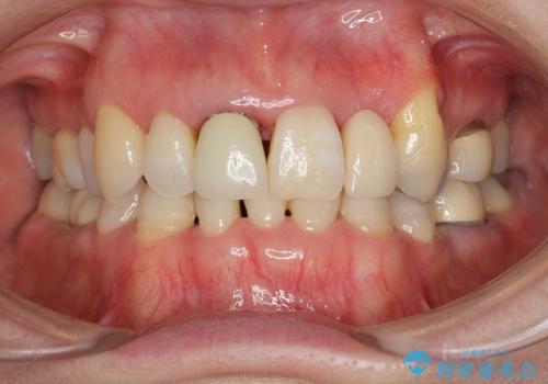 前歯ブリッジ　虫歯再発によるやりかえ治療の治療前