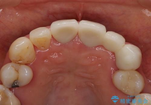 前歯ブリッジ　虫歯再発によるやりかえ治療の治療後