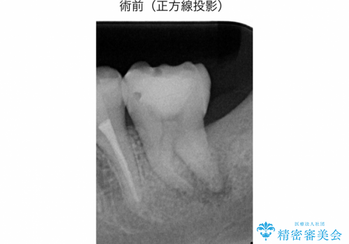 精密根管治療(イニシャルトリートメント):強度の湾曲根管を持つ大臼歯の症例の症例 治療前