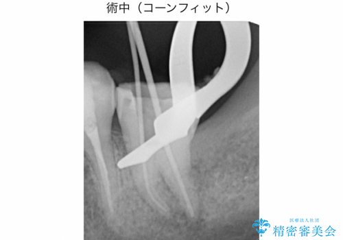 精密根管治療(イニシャルトリートメント):強度の湾曲根管を持つ大臼歯の症例の治療中