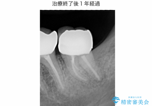精密根管治療(イニシャルトリートメント):強度の湾曲根管を持つ大臼歯の症例の症例 治療後
