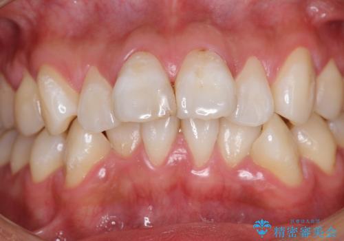 オールセラミックによる歯並びの改善の症例 治療前