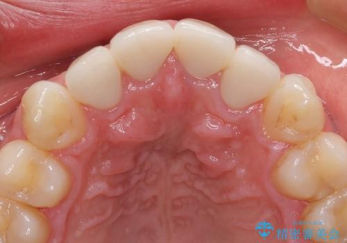 オールセラミックによる歯並びの改善の治療後