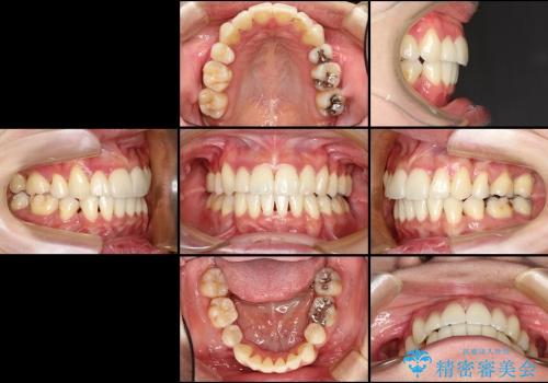 30代女性 八重歯を治したい 審美装置の治療後